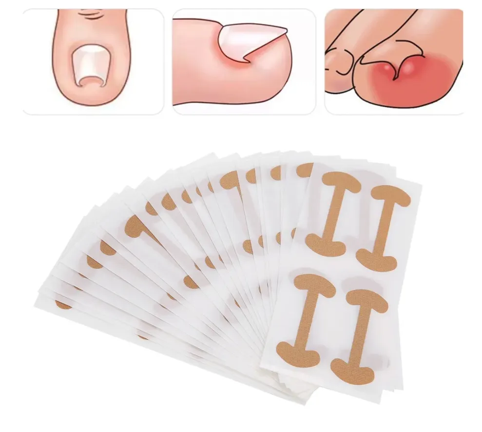 Пластыри для коррекции вросших ногтей