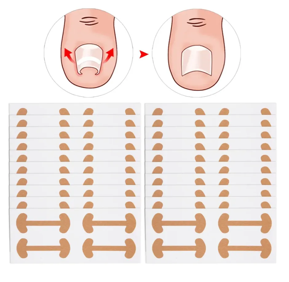 Пластыри для коррекции вросших ногтей