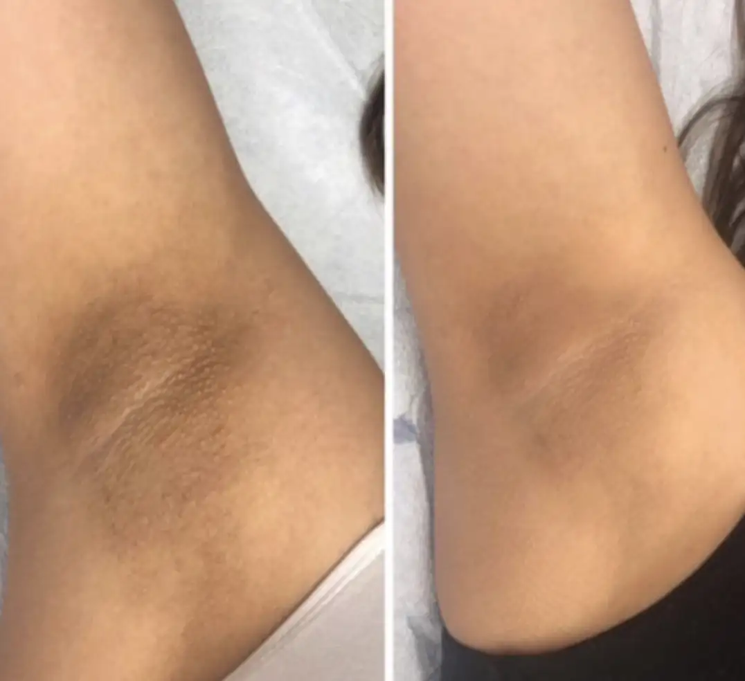 Выравнивание тона кожи после первого применения