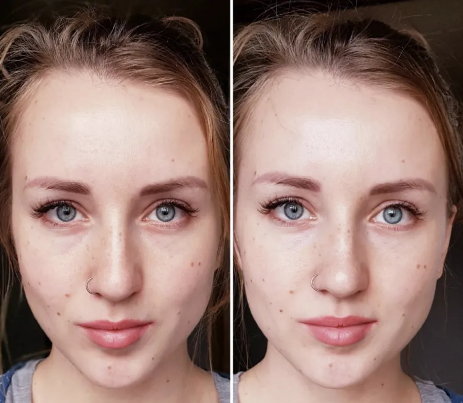 Патчи для носогубных складок