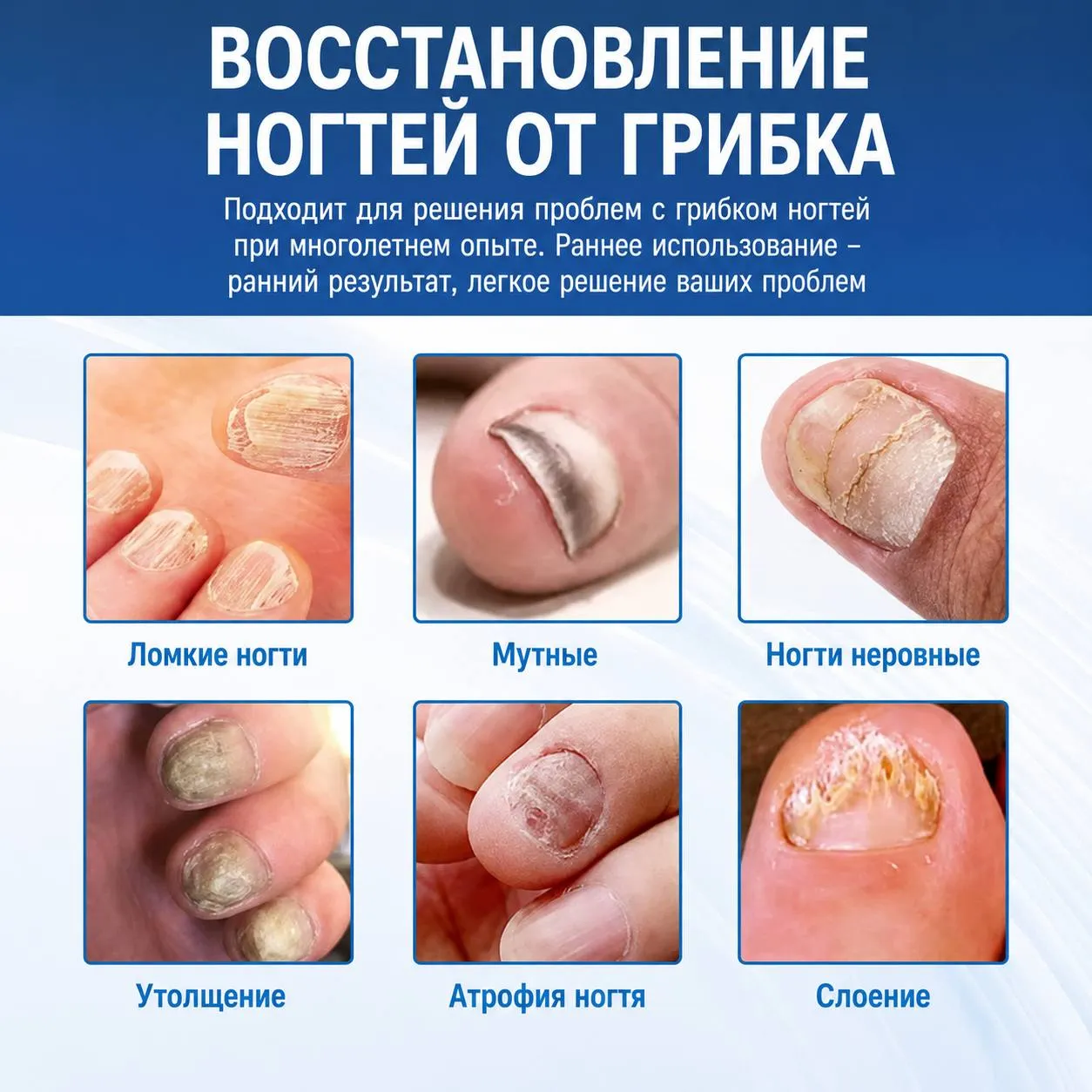 спрей от грибка ногтей