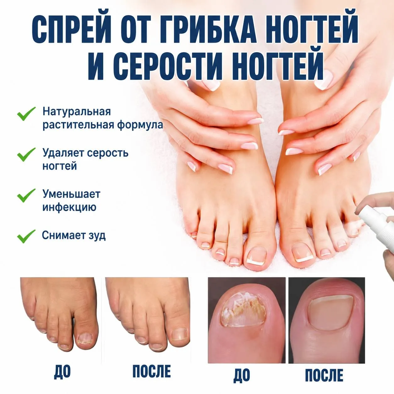 спрей от грибка ногтей