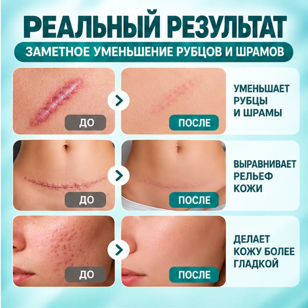 Спрей для ухода за шрамами и рубцами, 20 г