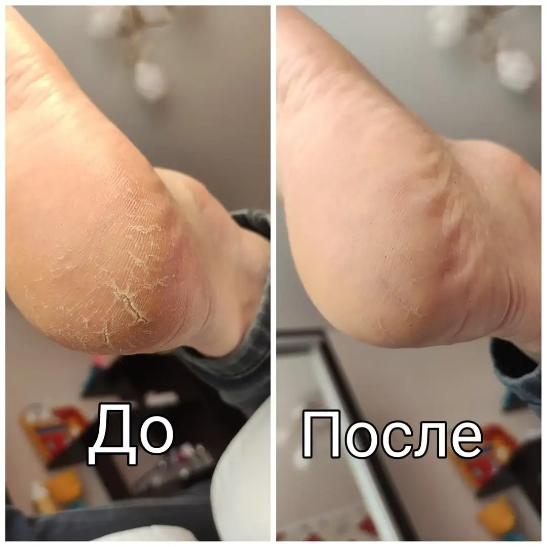 Устраняют сухость и трещины на пятках