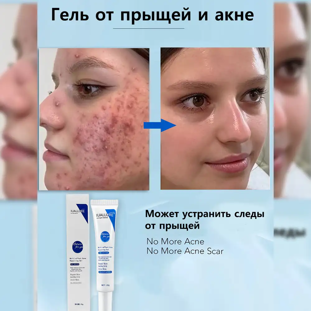 Очищающий гель против акне